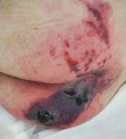 thin and tissues or patient show no infection Sharp debridement if infected or