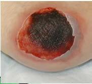 cellulitis, sepsis Debridement needs to be sharp for cellulitic wounds This