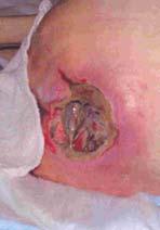 patients Bactroban for MRSA in DM Do not use as a long term dressing Cellular debris