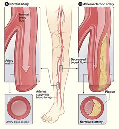 ischemia Sudden loss of limb perfusion that threatens the limb Can be critical limb ischemia Rest pain, ulceration/gangrene