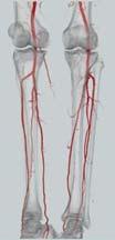 tibial to hear systolic ABI = systolic/ankle Interpretation