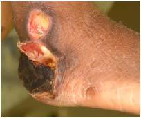 around wound Begin antibiotics DM often have MRSA Betadine paint Dress foot ulcer with dry