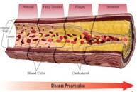 Arterial disease is progressive Patient and family may come to help to cure this when cure is
