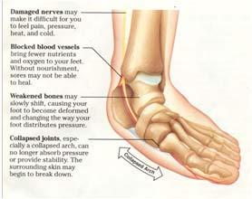to accumulate and slow production of nitric oxide Tightens ligaments in foot Injures the nerves