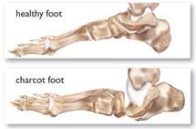 foot has a Called Charcot changes rocker deformity