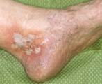 dermatitis Debridement Antiseptics silver common