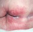 Intertrigo or Intertriginous Dermatitis inflammation in skin folds related to non-caustic fluids