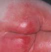wound exudate, associated with volume of exudate, its constituents and bacterial bioburden IAD