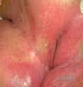 maceration IAD, mirrored wound Unstageable ischial ulcer Unstageable ischial ulcer Not certain Keep the
