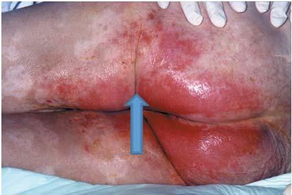 Red angry skin in areas exposed to urine