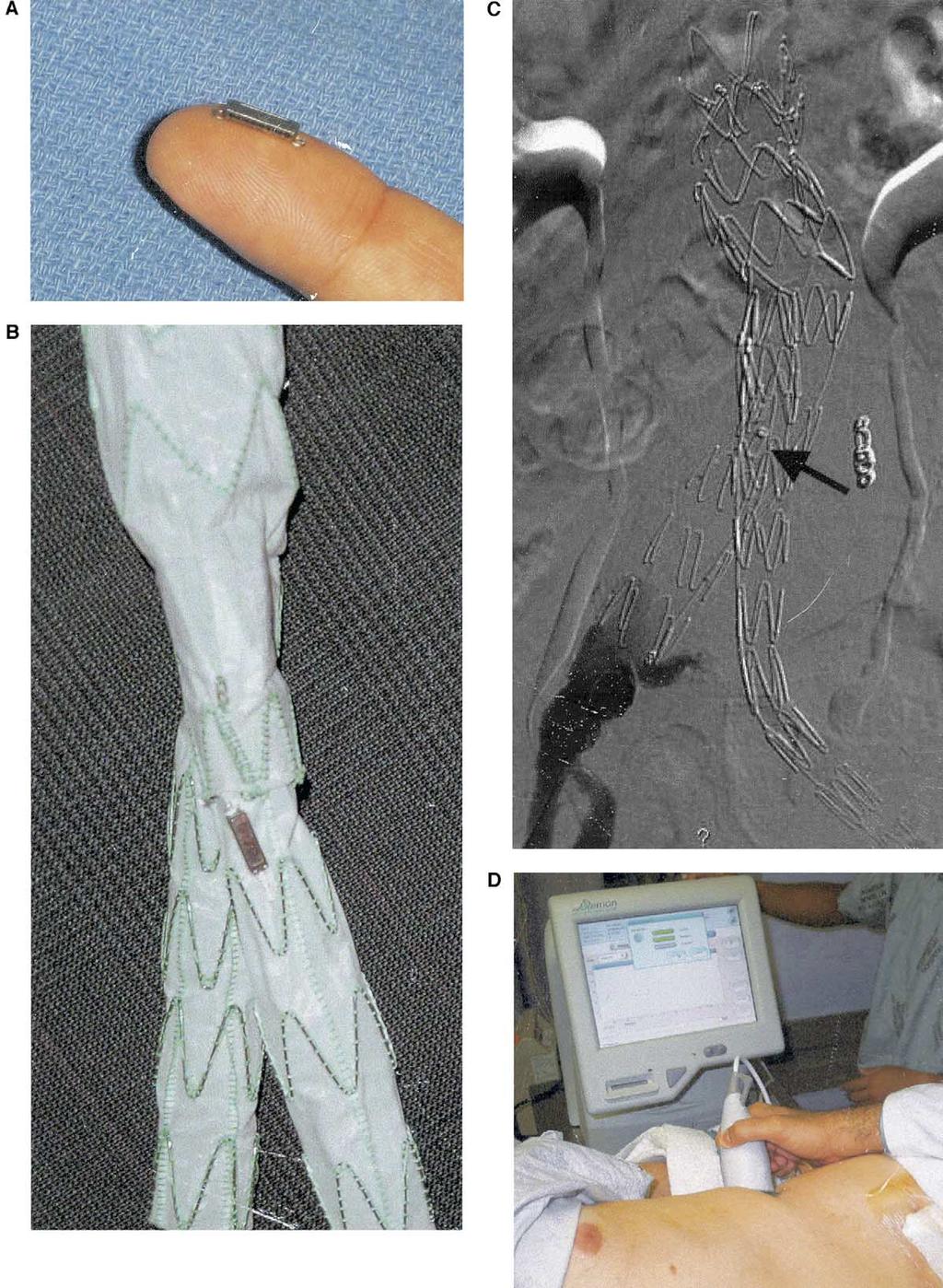 JOURNAL OF VASCULAR SURGERY Volume 40, Number 3 Ellozy et al 407 Fig 1. A, Impressure abdominal aortic aneurysm sac pressure transducer (Remon Medical).