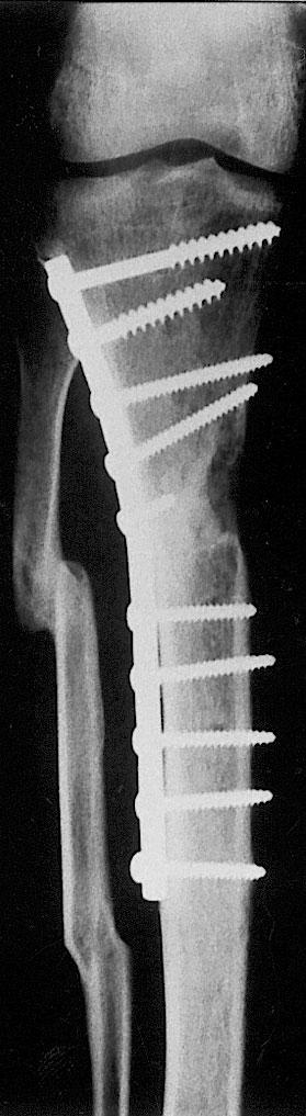 Three months after his discharge, the patient showed the well-healed skin, and radiography confirmed new bone formation.