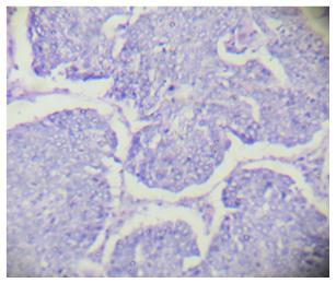 Adenocarcinoma Neoplastic cells are round to oval with pleomorphic nuclei, scanty cytoplasm, arranged in papillary pattern DISCUSSION: In the present study 840 specimens were analysed carefully.