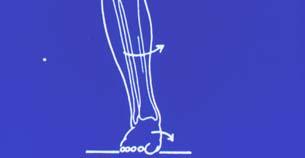 J Orthop Sports Phys Ther, 2003 Foot Pronation Tibia