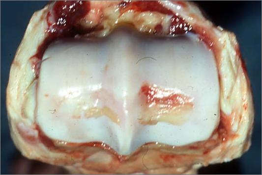 degradation Articular cartilage