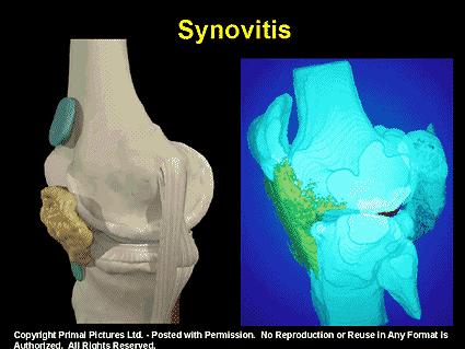 JOINT INJURY In the horse joint disease most commonly begins as traumatic synovitis secondary to use trauma.