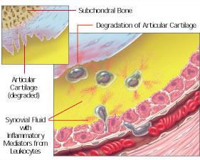 JOINT INJURY As WBCs enter the synovial fluid they undergo a respiratory burst releasing toxic oxygen radicals and enzymes.