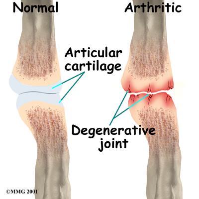 CARTILAGE LOSS When full thickness loss of cartilage occurs, this is permanent Hyaline cartilage is replaced with less resilient fibrocartilage No drug
