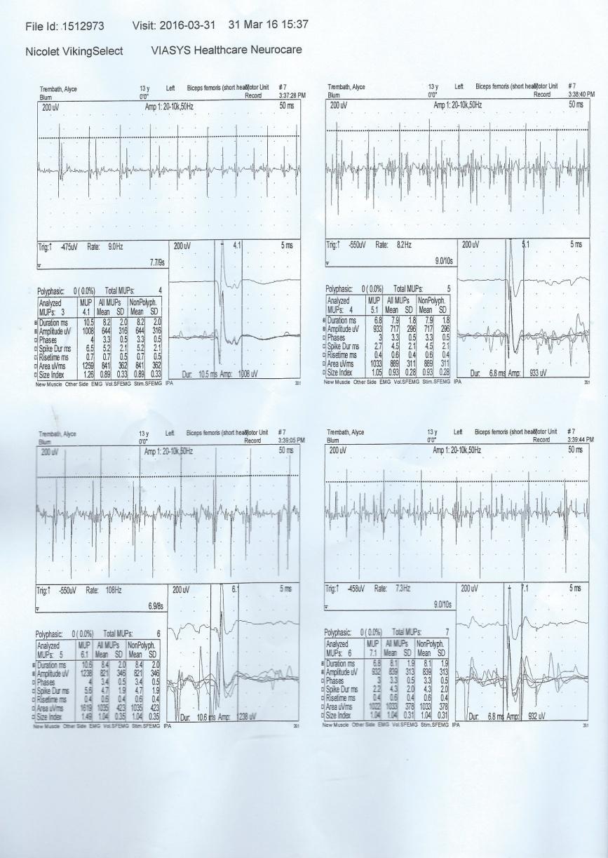 Interpreting EMG Insertional Activity Fibrillations