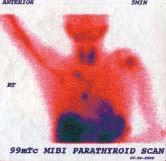 Figure 3 for washout technique showing abnormal scan that is positive for parathyroid adenoma on the left side involving the superior group.