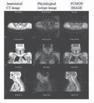 Fusion imaging (CT+tomographic nuclear imaging) The lesions seen in nuclear imaging are not associated with any anatomical details thereby making it mandatory for