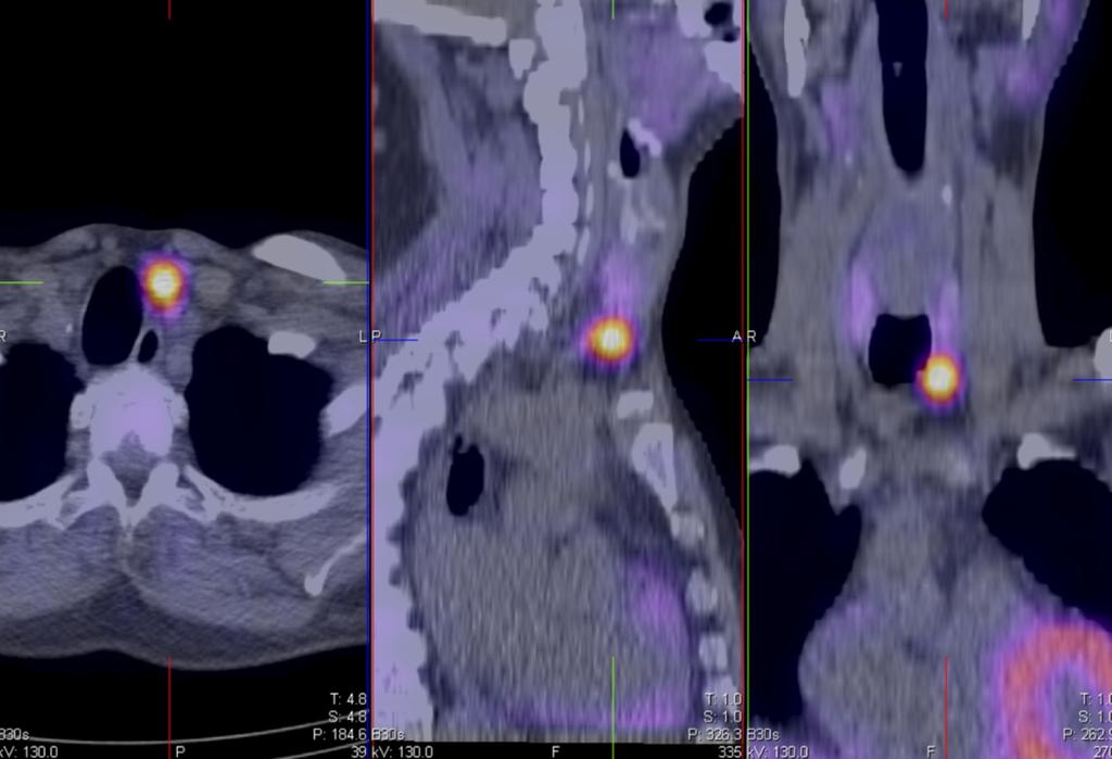 Fig. 11: Case 4: A 64-year-old man with chronic kidney disease and primary hyperparathyroidism. 99mTc-sestamibi SPECT/CT images confirm the focus of tracer retention correlating with a 1.