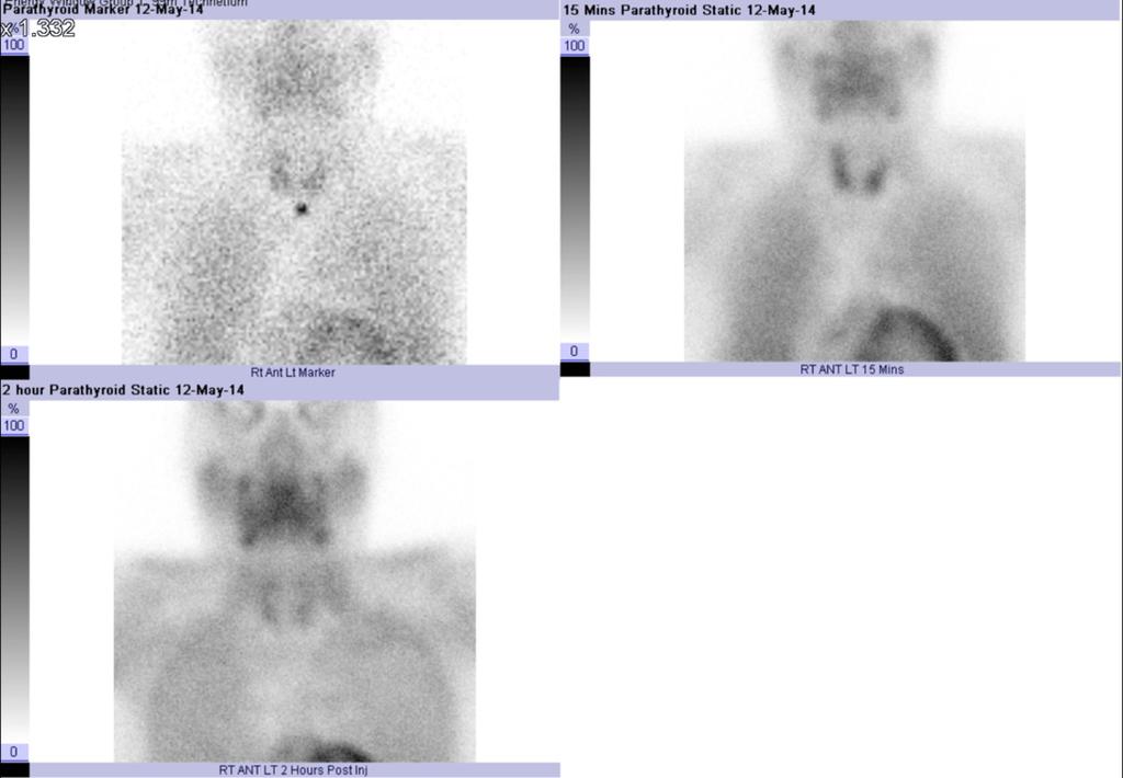Fig. 12: Case 5: A 52-year-old man with hyperparathyroidism, chronic kidney disease and osteoporosis.