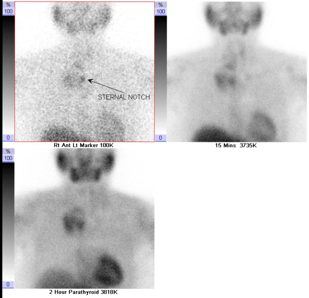 Fig. 17: Case 6: A 41-year-old woman with primary hyperparathyroidism.