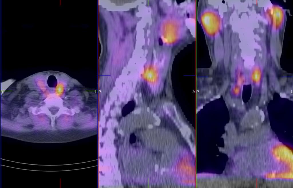 Fig. 27: Case 9: A 70-year-old man with a previous kidney transplant and primary hyperparathyroidism. 99mTc-sestamibi SPECT/CT images demonstrate the dominant abnormal focus to correspond to a 1.