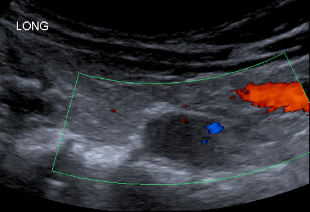 Fig. 5: Case 2: A 49-year-old man with primary hyperparathyroidism and a multiple endocrine neoplasia type 1. Neck ultrasonography demonstrates a 1.1 x 1.6 x 2.