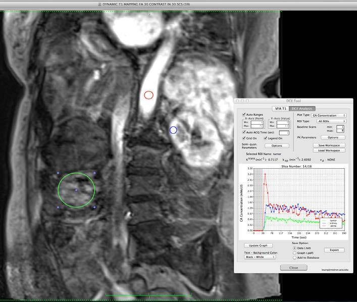 DCE-MRI Decreased Vascular Enhancement DCE-MRI on 28 Apr 2014; measured