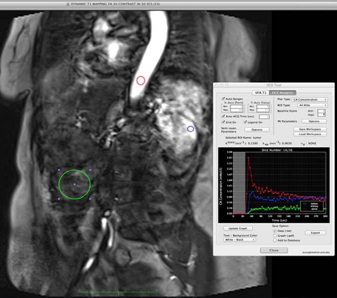 14-0.16 min-1 Red: aorta; blue: kidney; green: tumor.