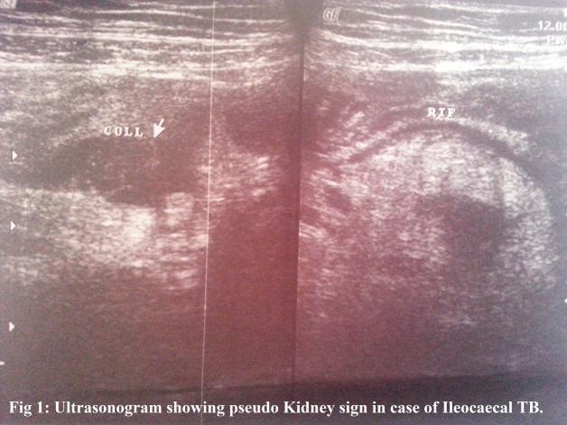 a. Ultrasonographic diagnosis of clinically non-palpable primary colonic neoplasms: BJR 1998, 61, 190-195. 8. N.G.B.Richardson, A.