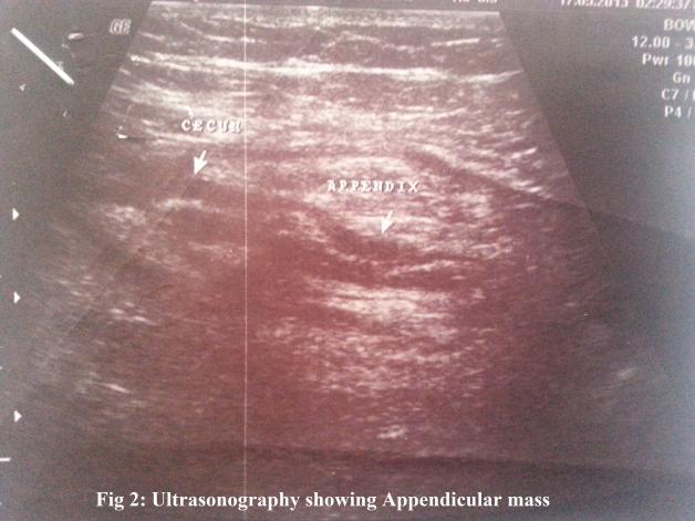 A Joseph: Abdominal Ultrasonography in the diagnosis of colonic cancer-bjs-1998:85, 530-535. 9. Ousehal A.et al.