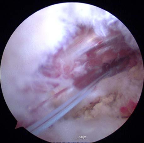 Arthroscopic Surgery Hip arthroscopic surgery on the 5 day of illness