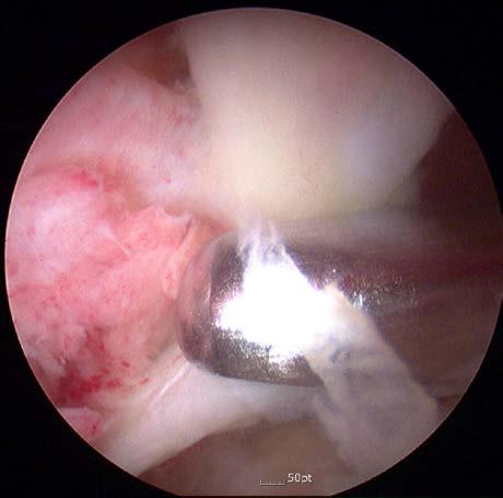 capsuloctomy to gain access to the iliopsoas bursa Drainage tube was
