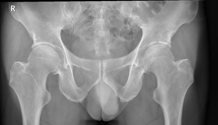 12-month Follow-up The ROM in the hip joint was unrestricted and the