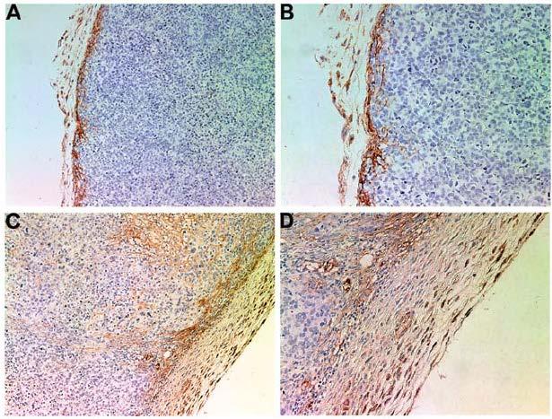 Effect of NM supplementation on Fibronectin Control 10 x magnification 20x magnification NM supplemented In tumors developed in control mice there was less fibronectin (brown spots) in the tumor mass