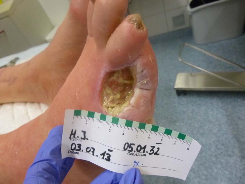 the foot due to the arterial disease, neuropathic foot.