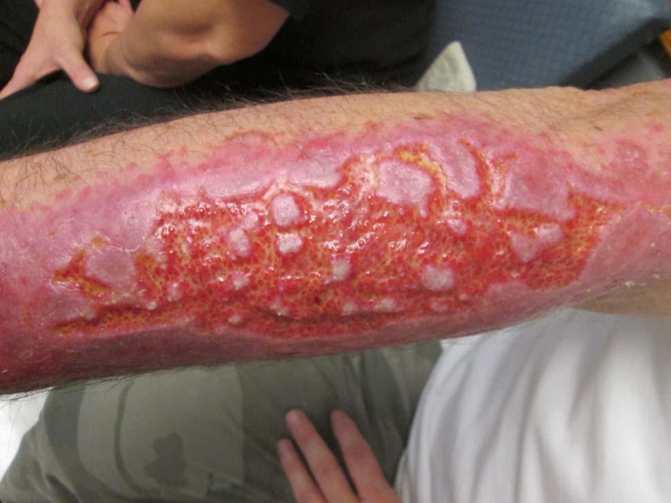 PATIENT 6 HISTORY: Patient received a 2nd degree burn of the R forearm on March 11, 2014.