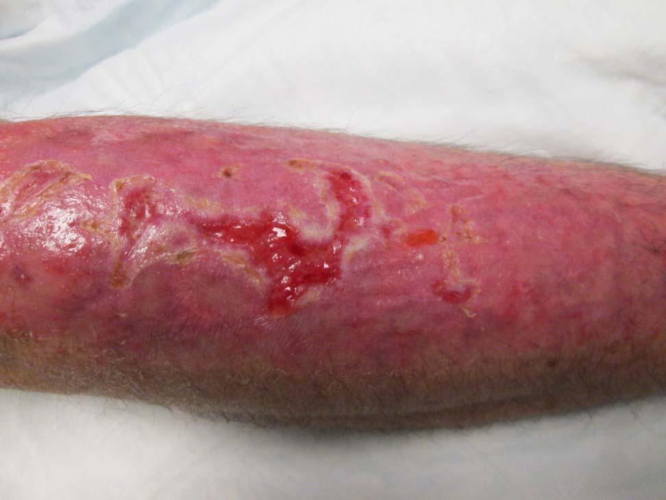 Patient presented to UVA April 9, 2014 for an evaluation of next steps skin graft recommended; patient refused.