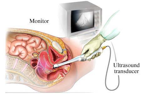 Transvaginal Ultrasound : Endometrial thickness should be measured on a sagittal (long axis) image of the uterus, and the measurement should be performed on the thickest portion of the endometrium,