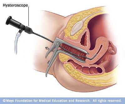 Hysteroscopy : Hysteroscopy is a procedure in which a small endoscope is inserted into the vagina and through the cervix to