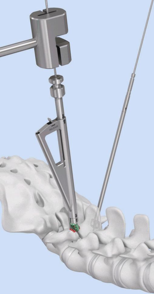 Insert implant 4 Insert implant Instrument(s) 03.630.35 Implant Holder for FACET WEDGE 03.630.38 Combined Hammer, Ø.