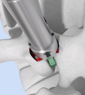 Disconnect the shaft of the implant holder from the implant by applying gentle medial or lateral pressure (4).