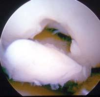 OSTEOCHONDRAL ALLOGRAFTS Considerations: Size of defect Availability of sizematched quality donor Extremity alignment Monopolar vs bipolar defects Ligamentous stability Meniscal injury OSTEOCHONDRAL