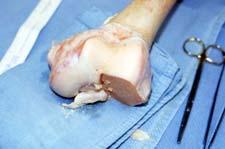 dissecans Age and size match OSTEOCHONDRAL