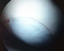 able to redistribute joint stress ARTICULAR CARTILAGE KEY POINTS Fibrocartilage will fill the