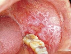 Oropharynx Oral lichen planus Behcet s