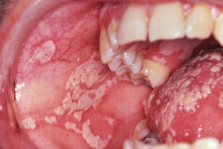 Leukoplakia/actinic cheilitis HSV Oral